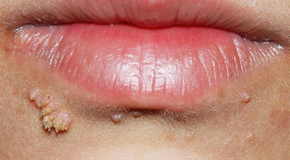 Verrugas en los labios